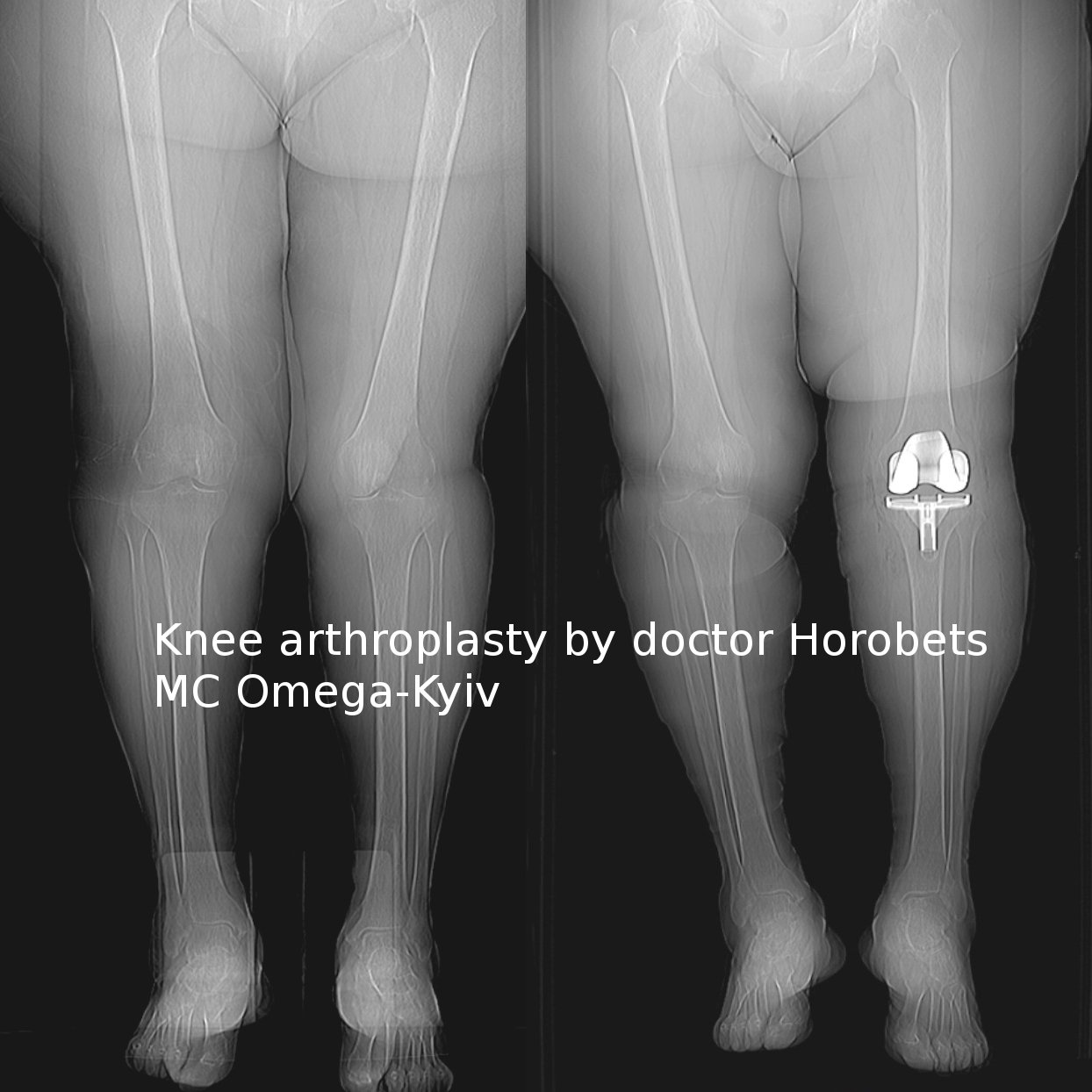 Arthritis / Ortho