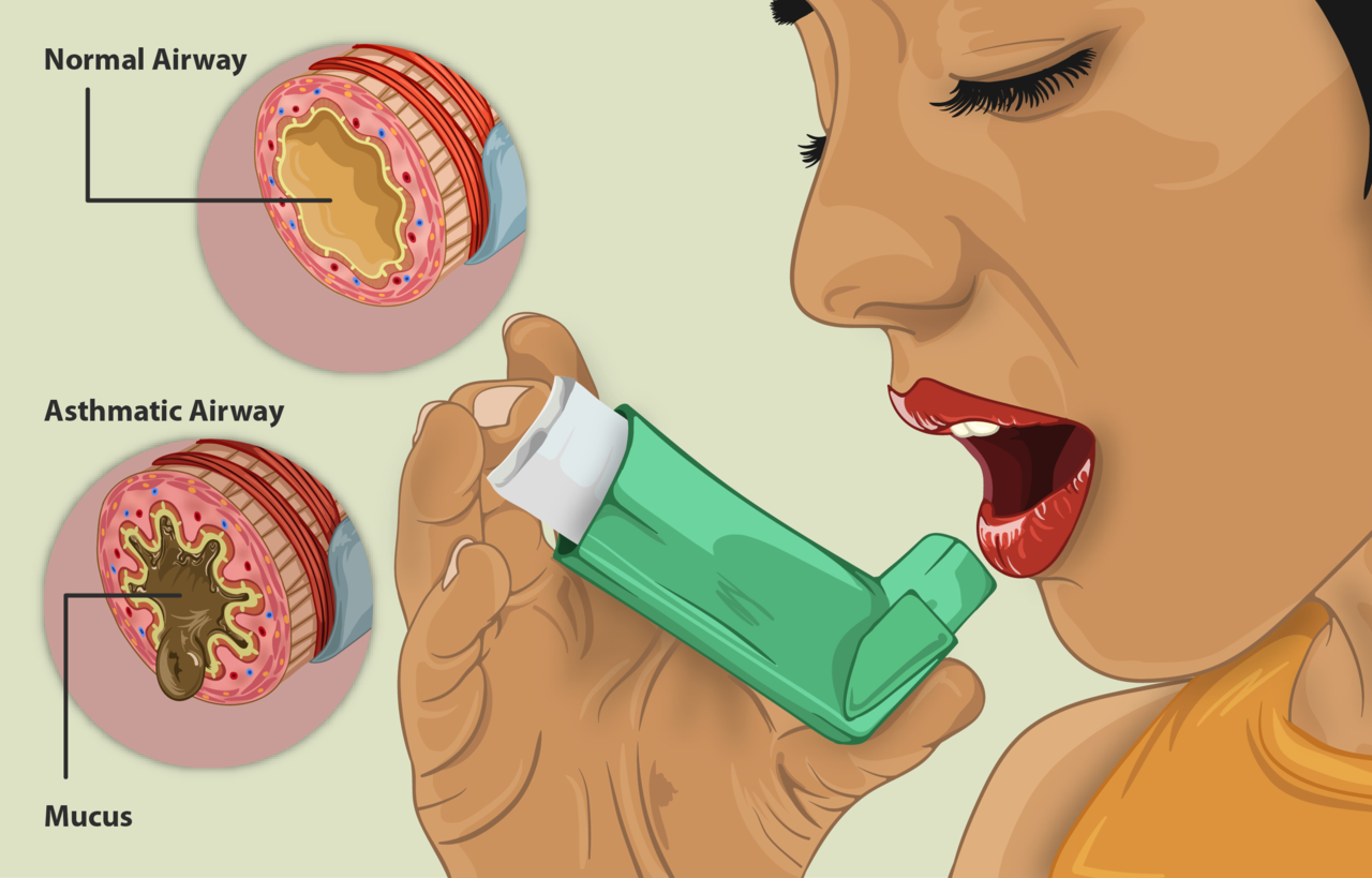 Asthma