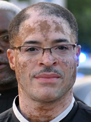 Vitiligo