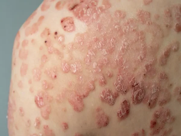 PSORIASIS