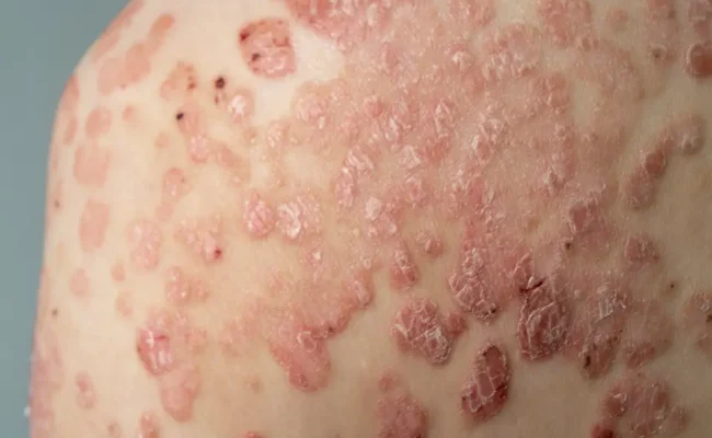 PSORIASIS